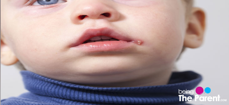 cold sores in babies