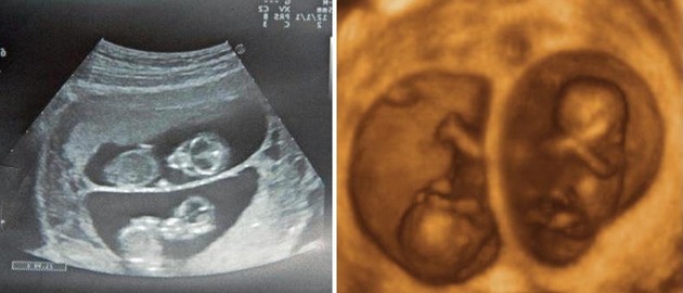 11 weeks ultrasound twins pictures