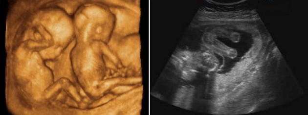 20 weeks ultrasound twins pictures