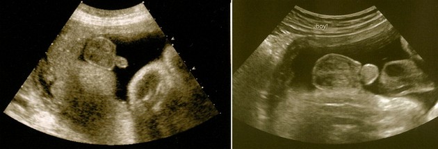 34 Week Ultrasound Boy