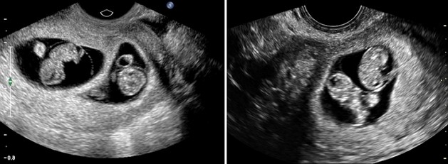 8 weeks ultrasound twins pictures