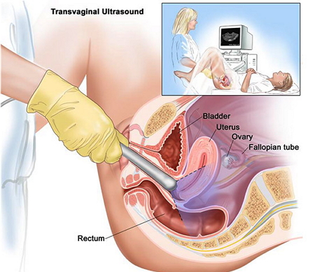 Transvaginal Ultrasound During Early and Late Pregnancy