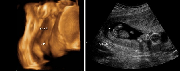 31 Week Ultrasound Girl