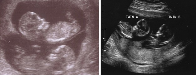 13 weeks ultrasound twins pictures