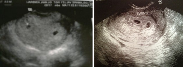 1 week ultrasound twins pictures