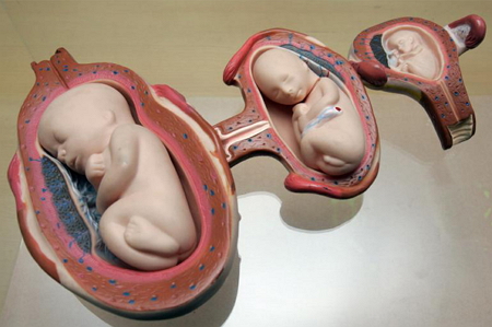 fetus parasite