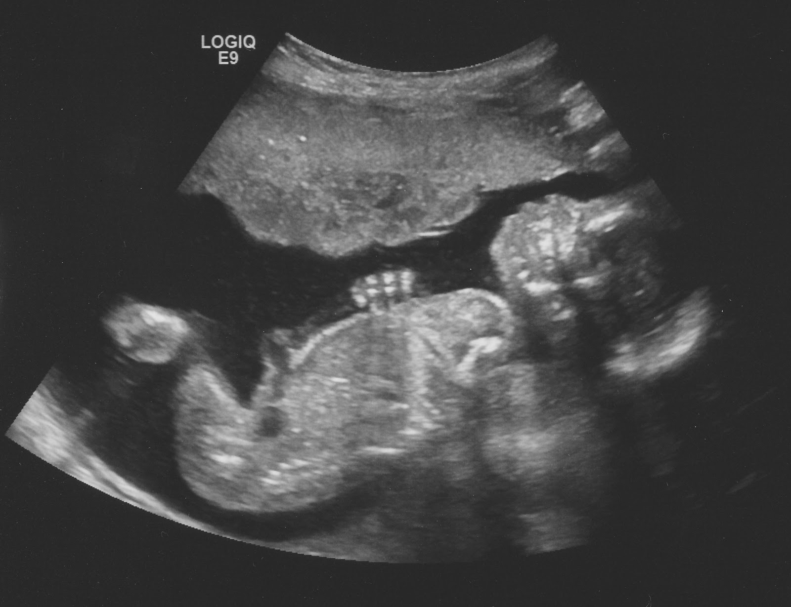8 Months Ultrasound Boy