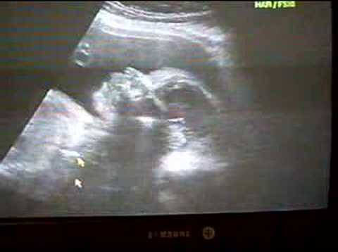 6 Months Ultrasound Boy