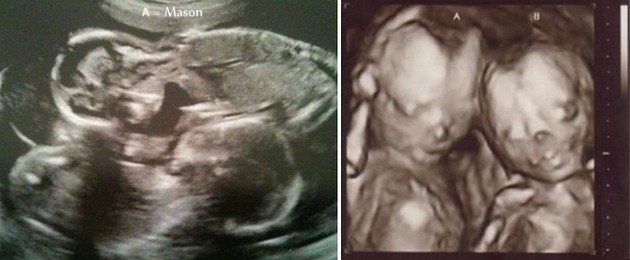 27 weeks ultrasound twins pictures