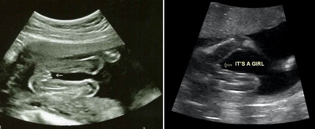 20 Week Ultrasound Girl