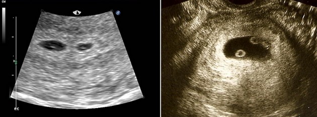 3 weeks ultrasound twins pictures