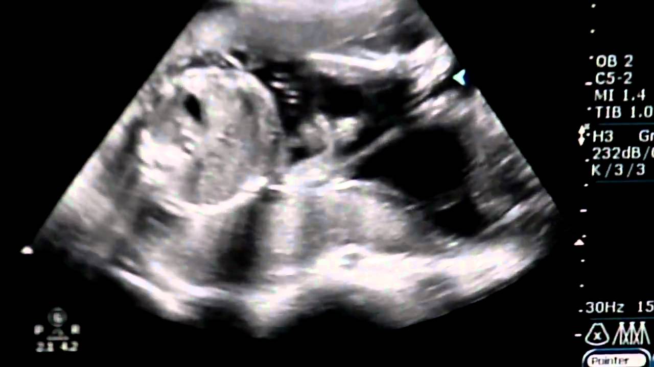ultrasound of twins at 6 months