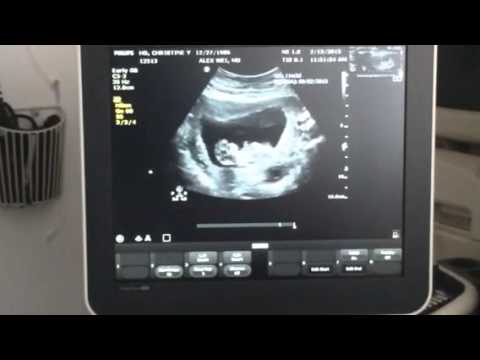 3 Months Ultrasound Boy