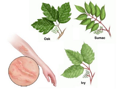 Poison Ivy, Oak and Sumac in Children