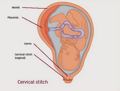 Cervical Cerclage Procedure
