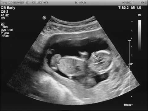 14 Week Ultrasound Girl
