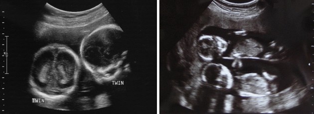 14 weeks ultrasound twins pictures