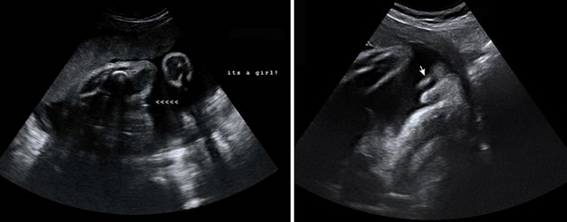 32 Week Ultrasound Girl