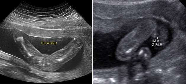18 Week Ultrasound Girl