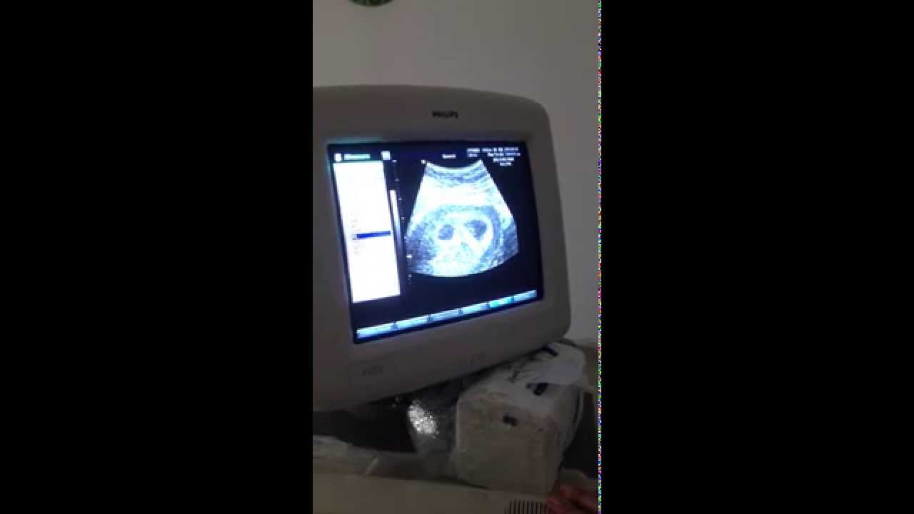 ultrasound of twins at 1 month
