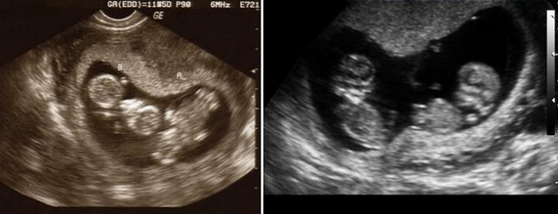 12 weeks ultrasound twins pictures