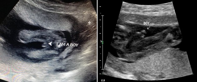 18 Week Ultrasound Boy