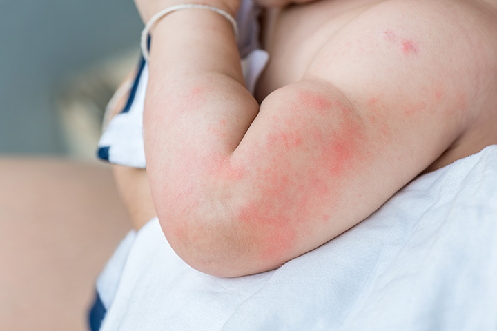 Hives in Babies