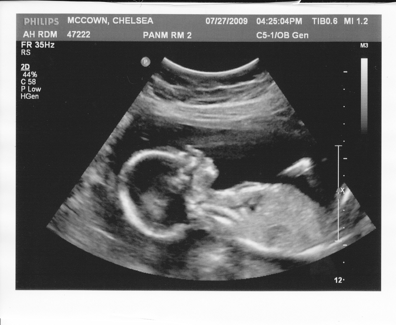 ultrasound at 2 months pregnant