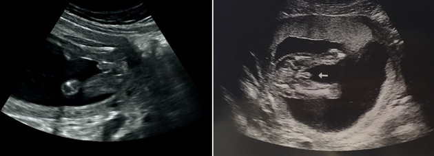 17 Week Ultrasound Boy