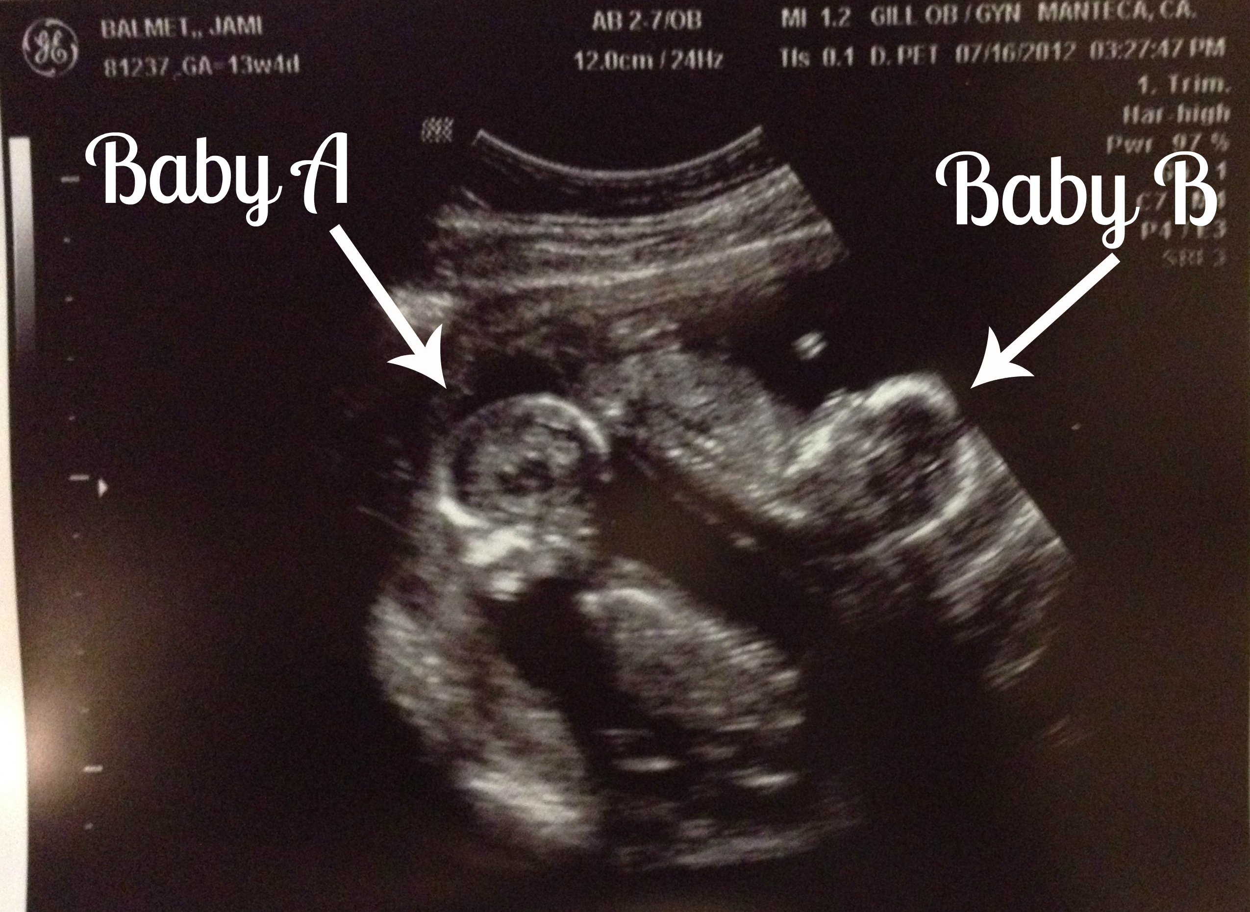 ultrasound of twins at 4 months