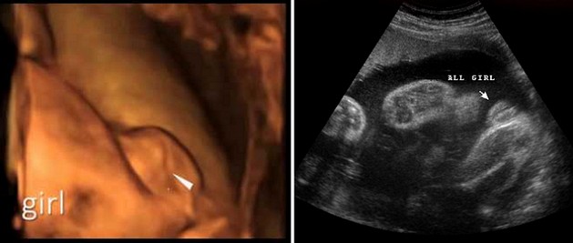 28 Week Ultrasound Girl