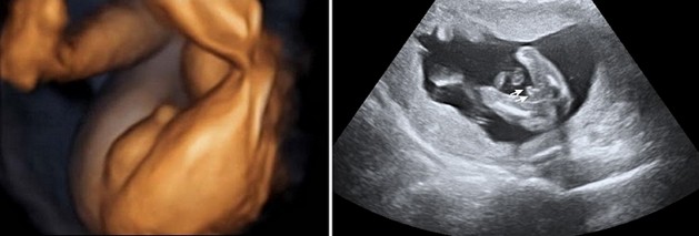 25 Week Ultrasound Boy