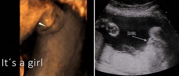 26 Week Ultrasound Girl