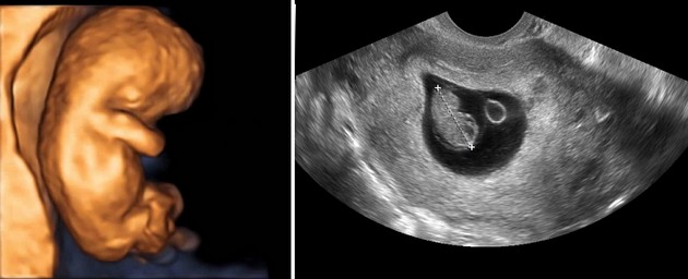 9 weeks ultrasound photo