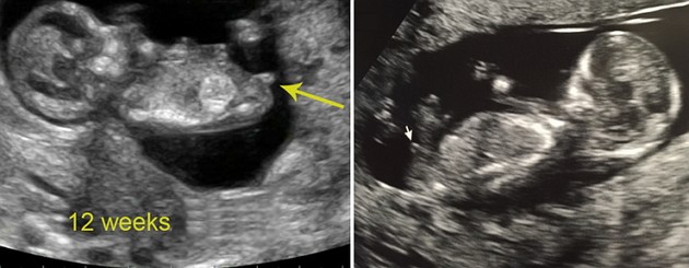 12 Week Ultrasound Boy