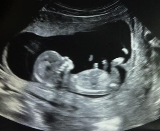 3 Months Ultrasound Girl