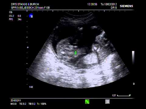 5 Months Ultrasound Boy