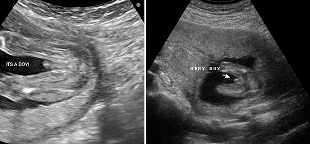 23 Week Ultrasound Boy