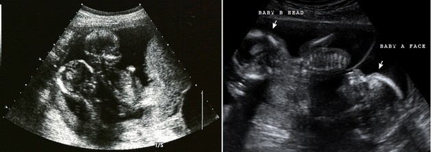 19 weeks ultrasound twins pictures