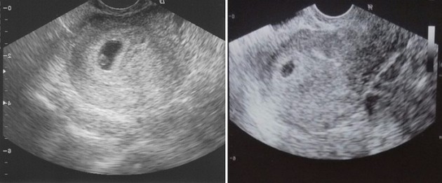 4 weeks ultrasound photo