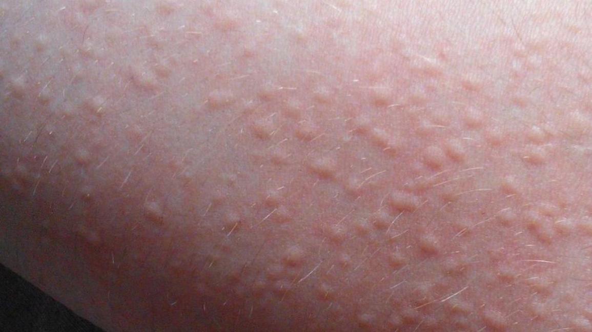 Urticaria rashes