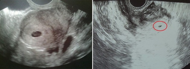 3 weeks ultrasound photo