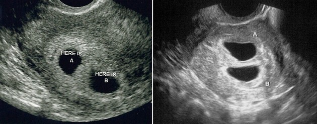 Weeks 4 ultrasound at Sonogram Secrets