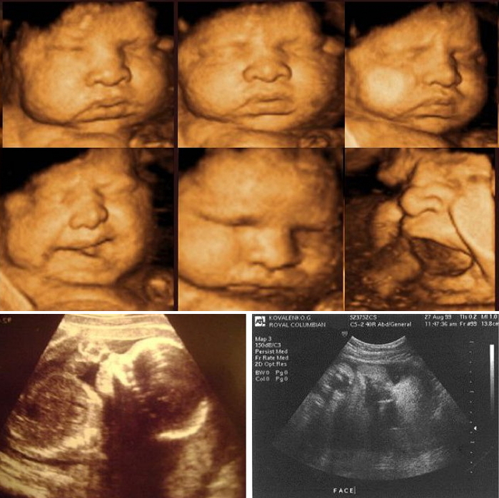 ultrasound at 10 months pregnant