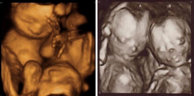 29 weeks ultrasound twins pictures