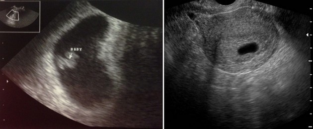 5 weeks ultrasound photo