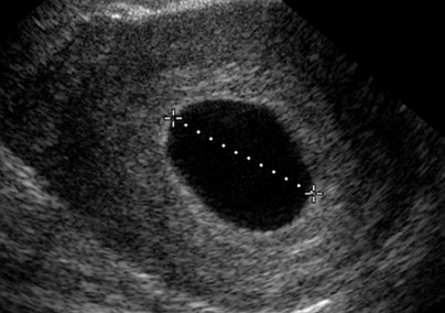 blighted ovum ultrasound