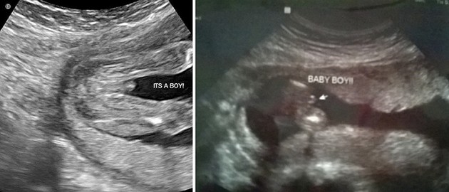 16 Week Ultrasound Boy
