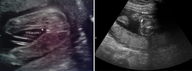 23 Week Ultrasound Girl
