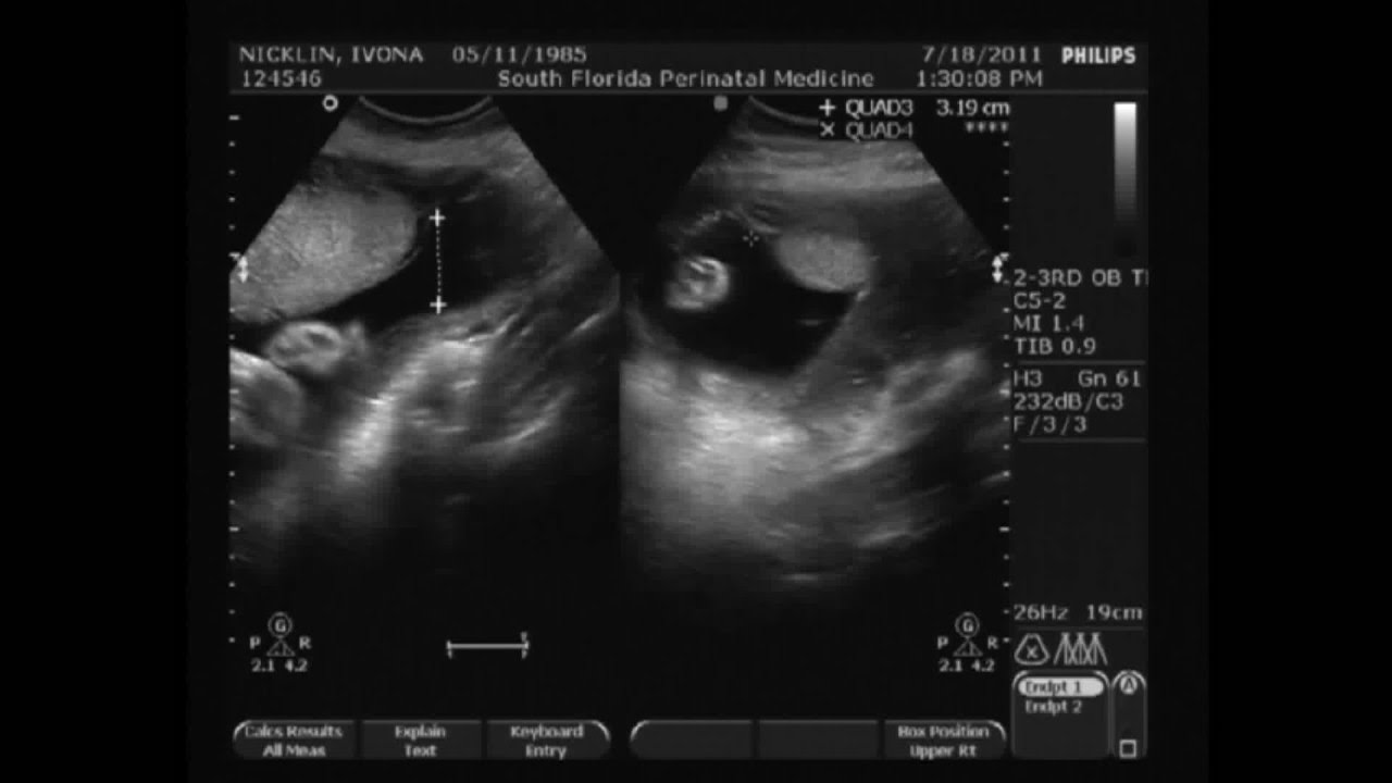 29 Week Ultrasound Girl